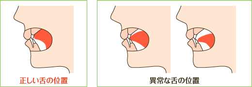 舌 の 正しい 位置