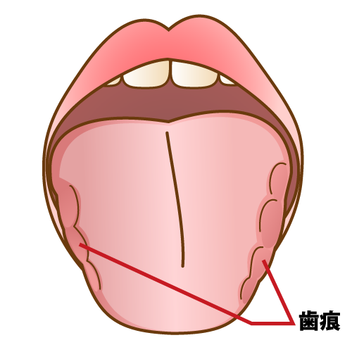 舌 歯 の 跡 が つく