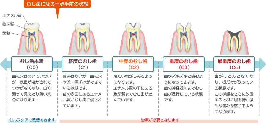 むし歯の進行のイラスト