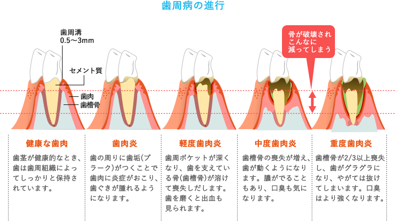 清瀬市 松山の歯医者清瀬いんどう歯科 歯周病