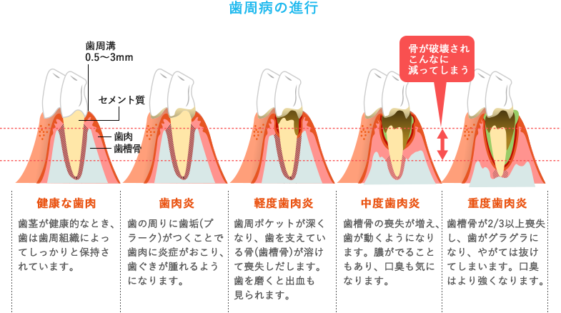 歯周病の進行イラスト